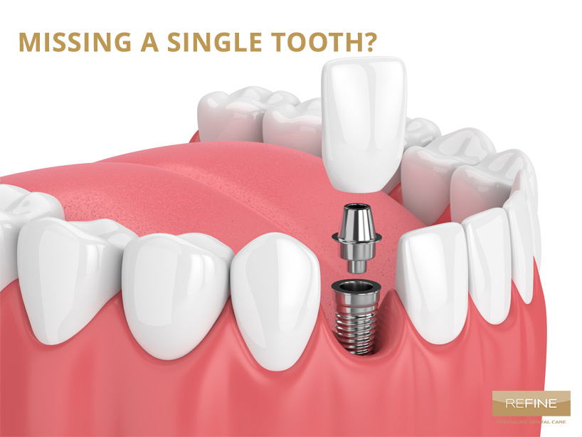 MISSING A SINGLE  TOOTH?