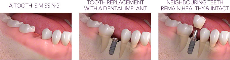 dental implants at refine dental care