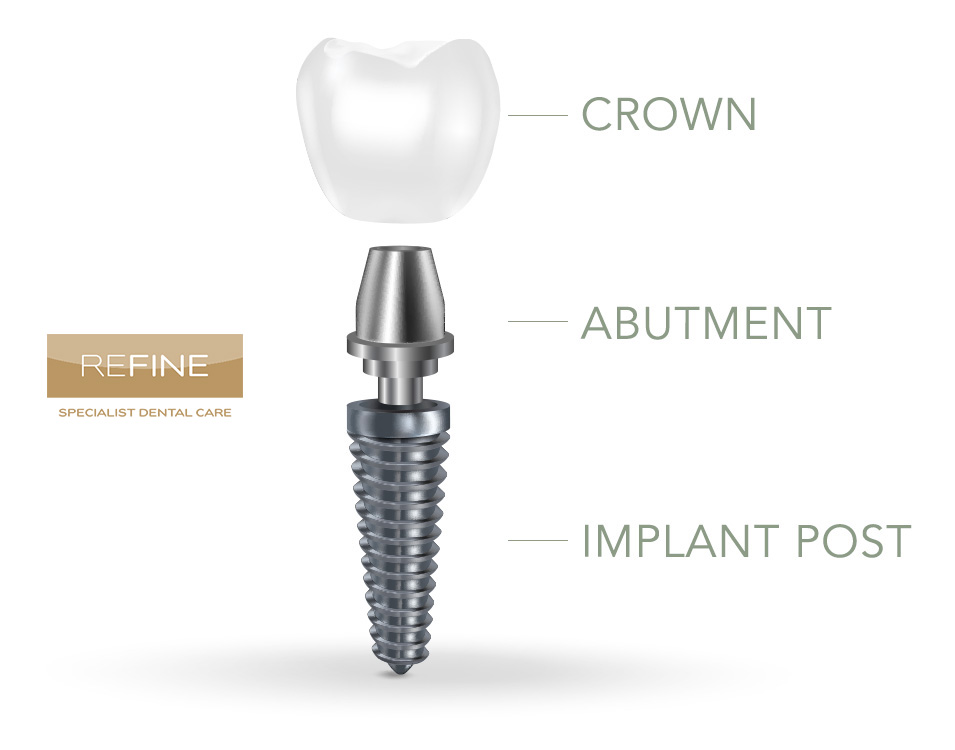 Dental Implants in Alfreton, Derbyshire