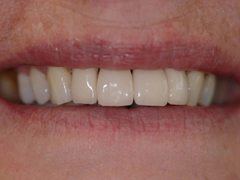 Dental Implants in North Derbyshire | Alfreton - after treatment
