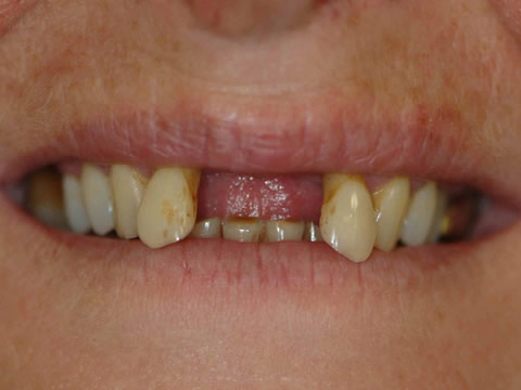Dental Implants in North Derbyshire | Alfreton  before treatment