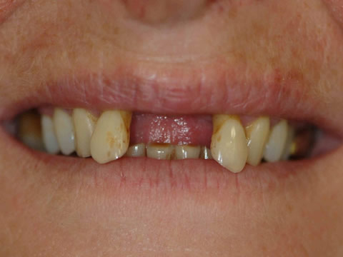 dental implants in Alfreton