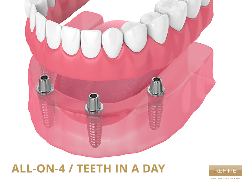 ALL-ON-4 DENTAL IMPLANTS