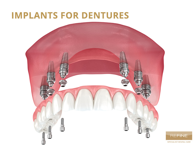 DENTURES WITH IMPLANTS