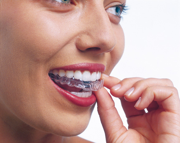 invisalign North Derbyshire