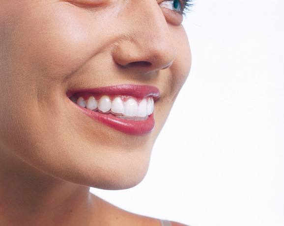 invisalign the clear alternative to braces