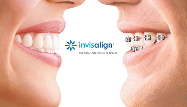 WHAT IS INVISALIGN?