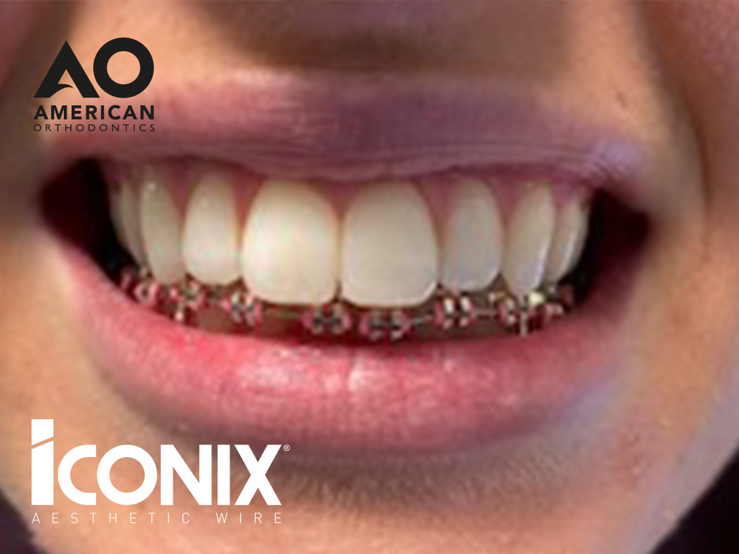 iconix braces straight teeth