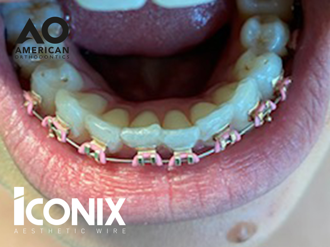 iconix braces straight smile