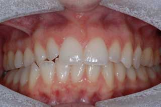 	TEETH WHITENING
