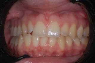 	TEETH WHITENING